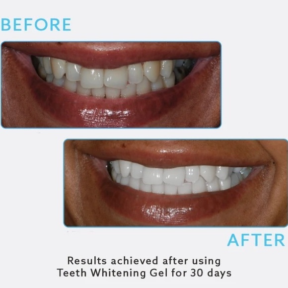 Go Smile Teeth Whitening Gel NIB 3.4 oz - Picture 4 of 9